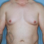 Gynecomastia Before & After Patient #718
