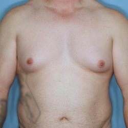 Gynecomastia Before & After Patient #718