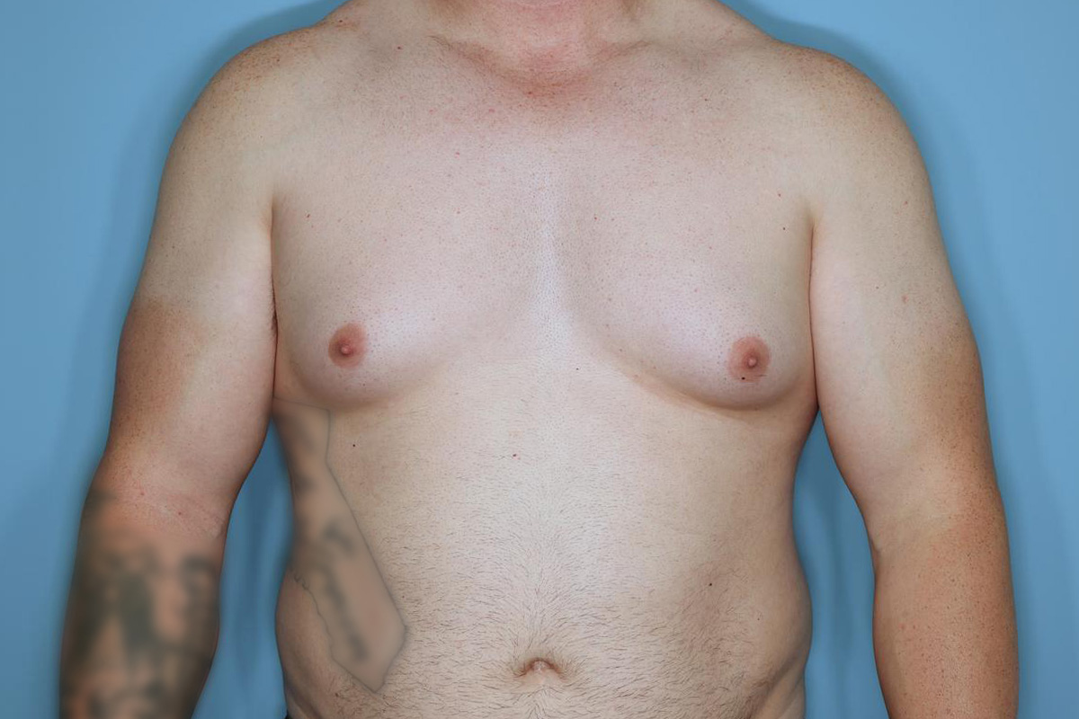 Gynecomastia Before & After Patient #718
