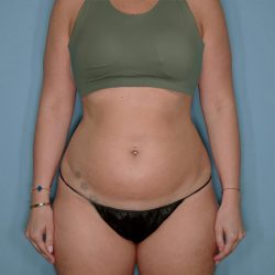 Liposuction and Renuvion J Plasma Before & After Patient #720