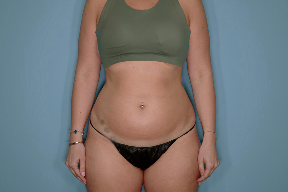 Liposuction and Renuvion J Plasma Before & After Patient #720
