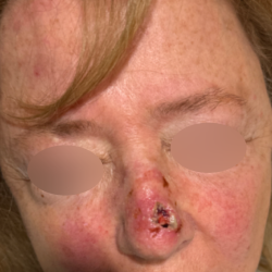 Skin Cancer Reconstruction Before & After Patient #656