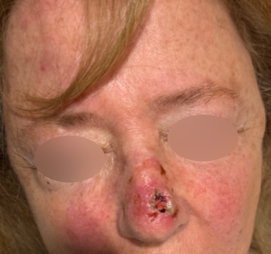 Skin Cancer Reconstruction Before & After Patient #656