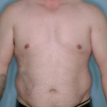 Gynecomastia Before & After Patient #718