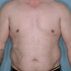 Gynecomastia Before & After Patient #718