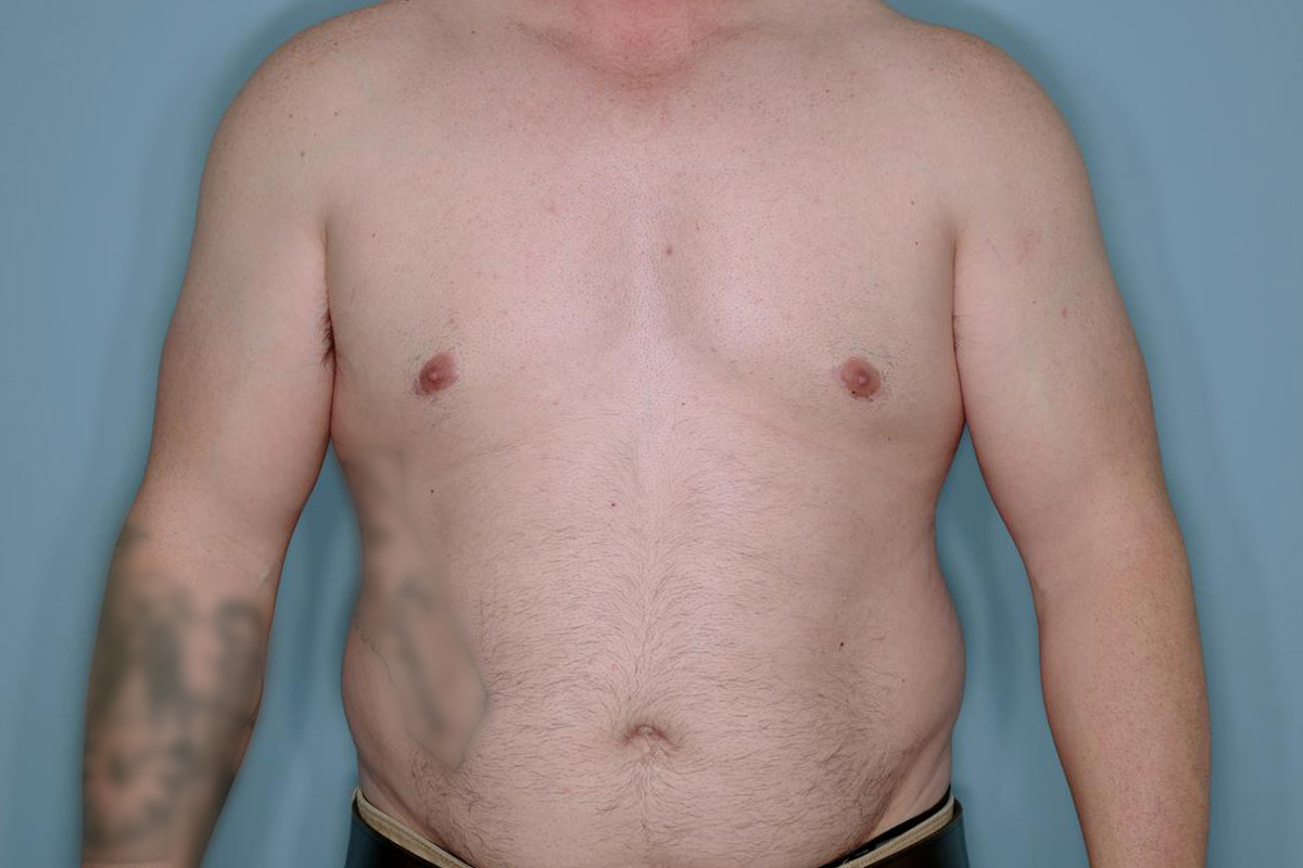 Gynecomastia Before & After Patient #718