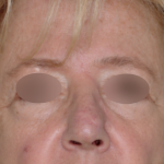 Skin Cancer Reconstruction Before & After Patient #656