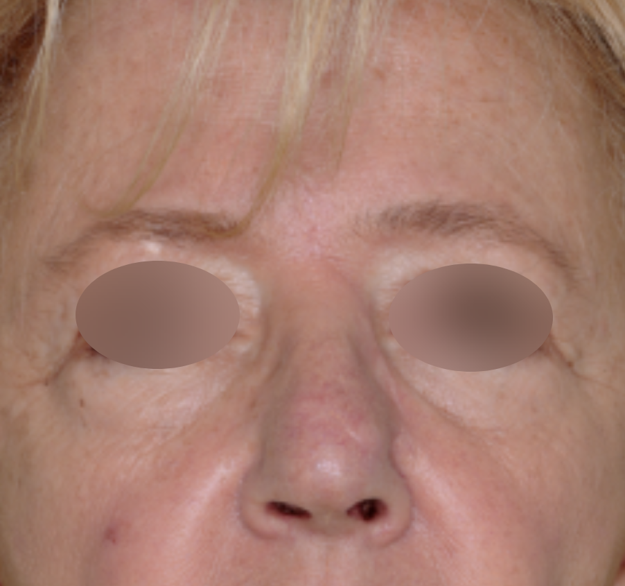 Skin Cancer Reconstruction Before & After Patient #656