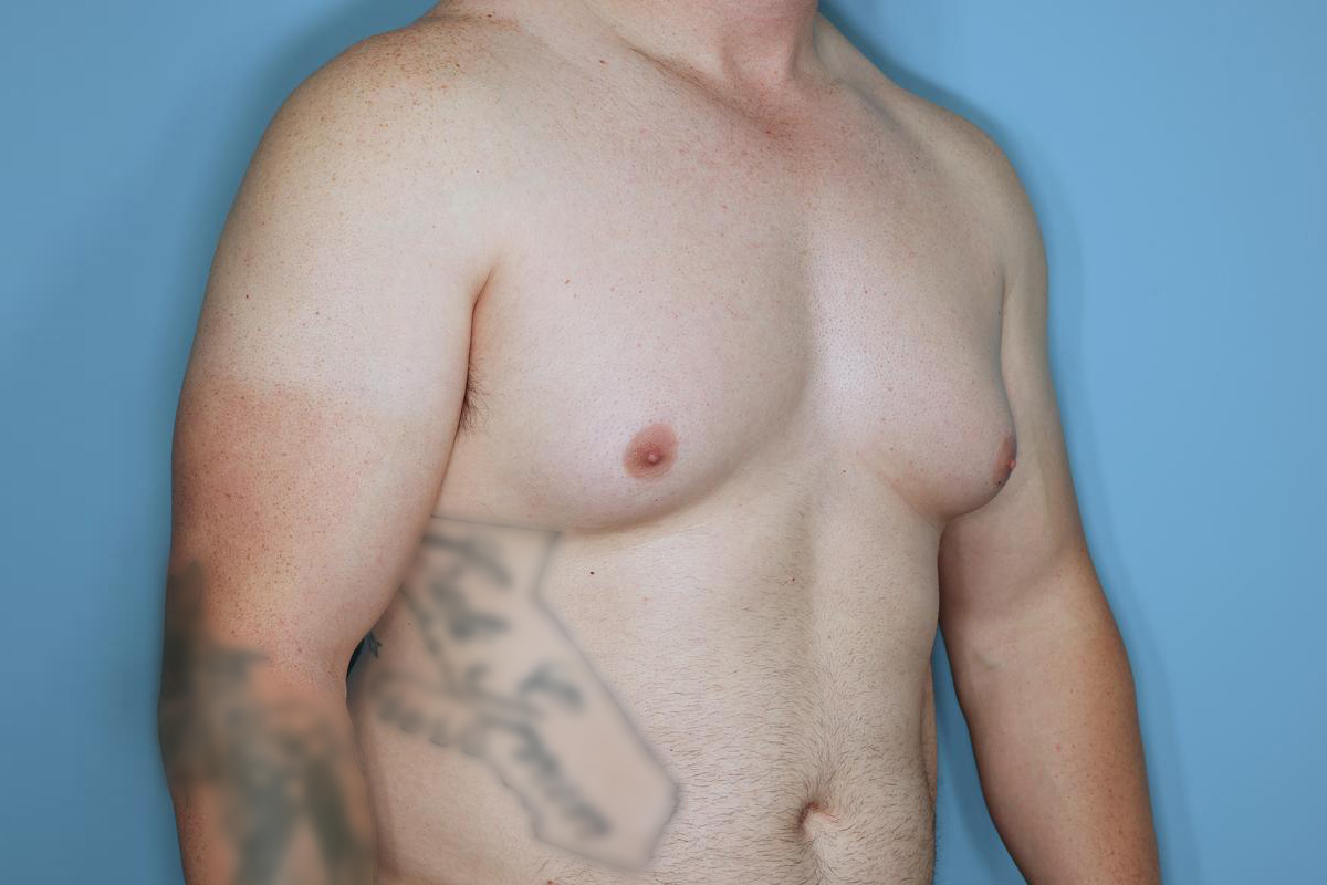 Gynecomastia Before & After Patient #718