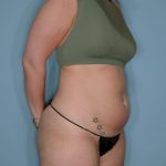Liposuction and Renuvion J Plasma Before & After Patient #720