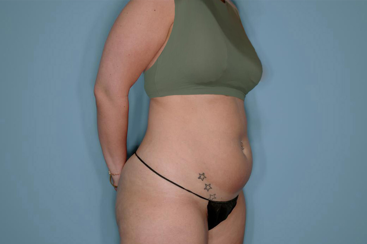 Liposuction and Renuvion J Plasma Before & After Patient #720