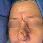 Skin Cancer Reconstruction Before & After Patient #656