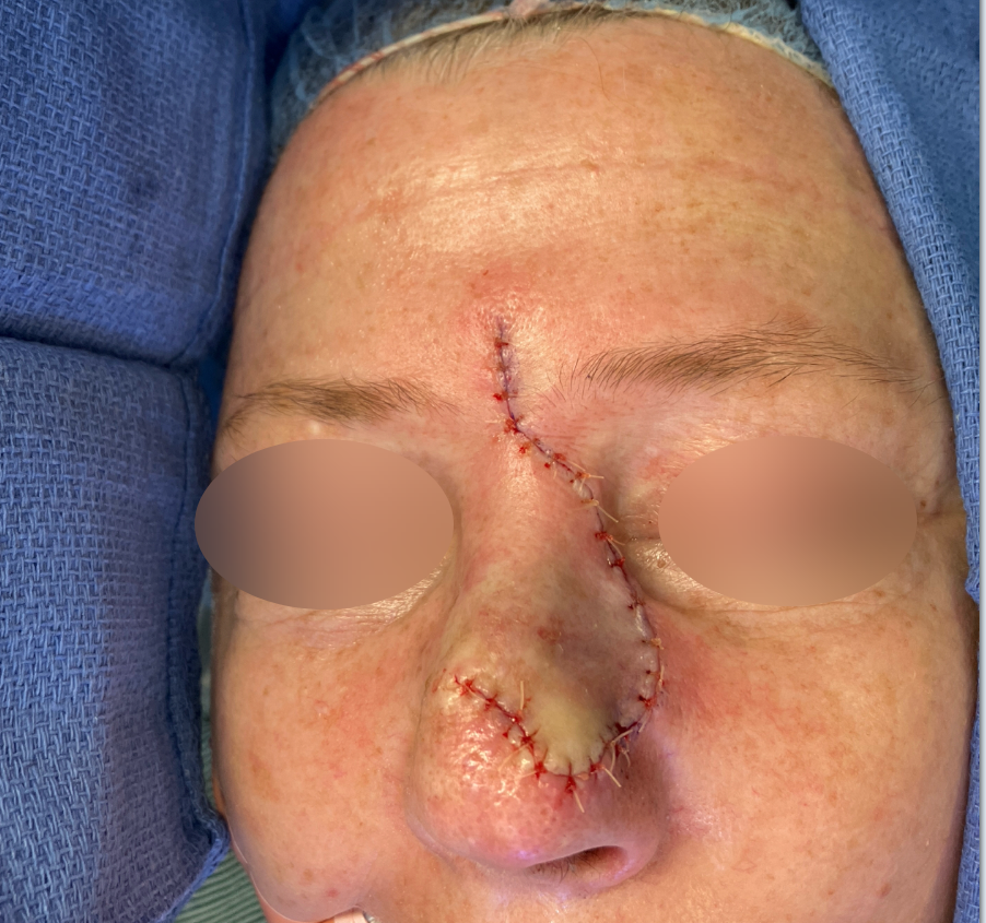Skin Cancer Reconstruction Before & After Patient #656