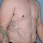 Gynecomastia Before & After Patient #718