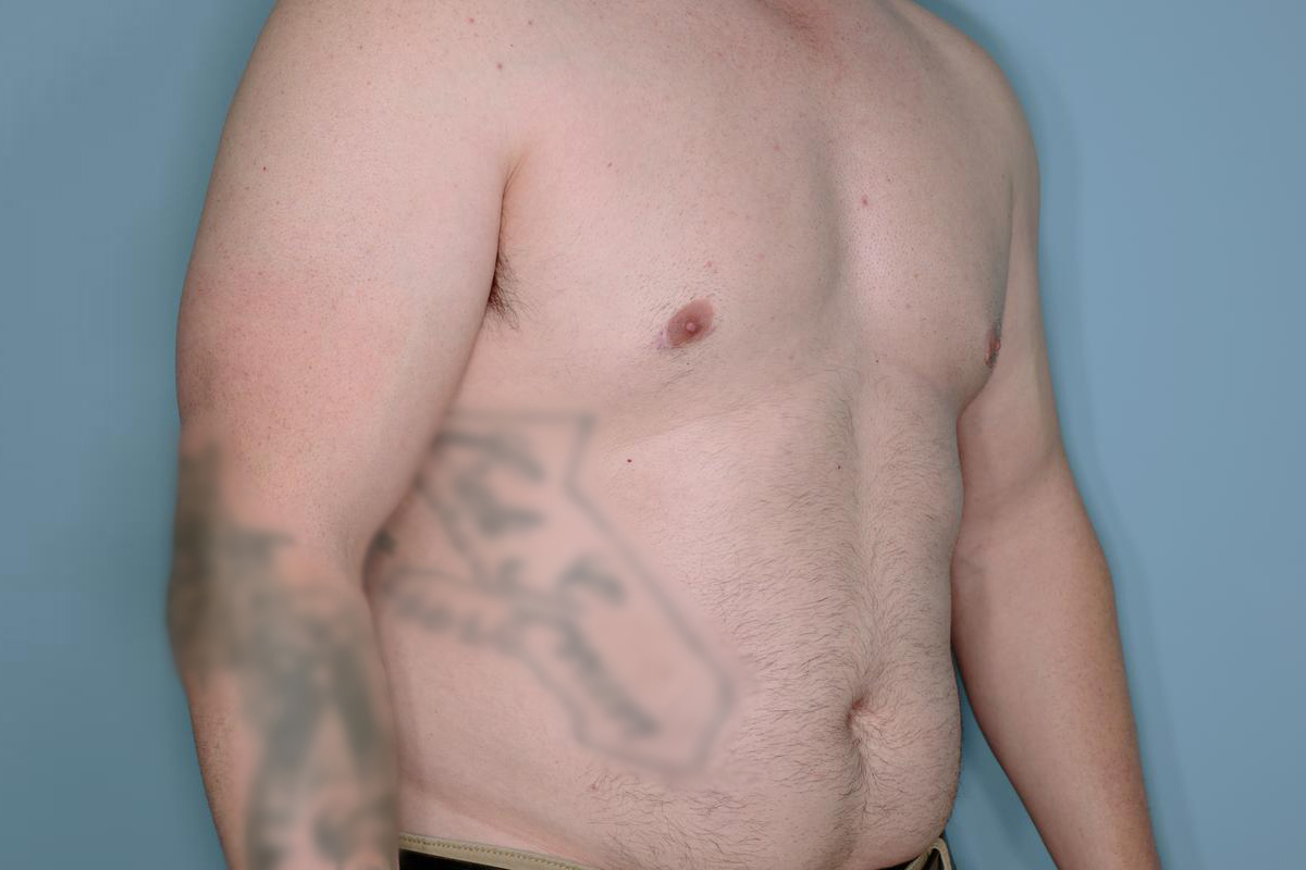 Gynecomastia Before & After Patient #718