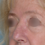 Skin Cancer Reconstruction Before & After Patient #656