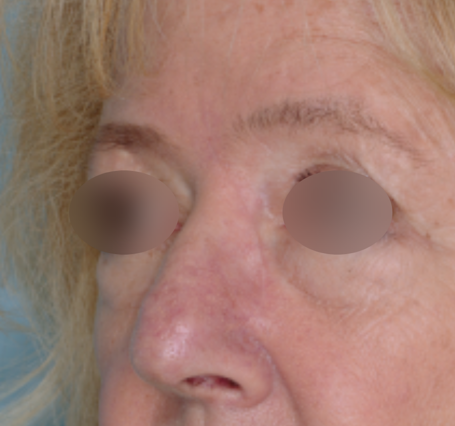 Skin Cancer Reconstruction Before & After Patient #656