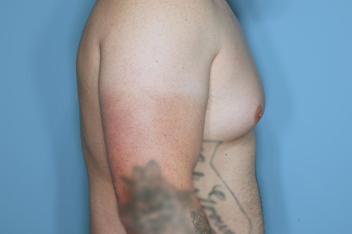 Gynecomastia Before & After Patient #718