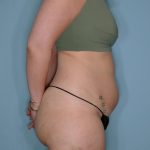 Liposuction and Renuvion J Plasma Before & After Patient #720