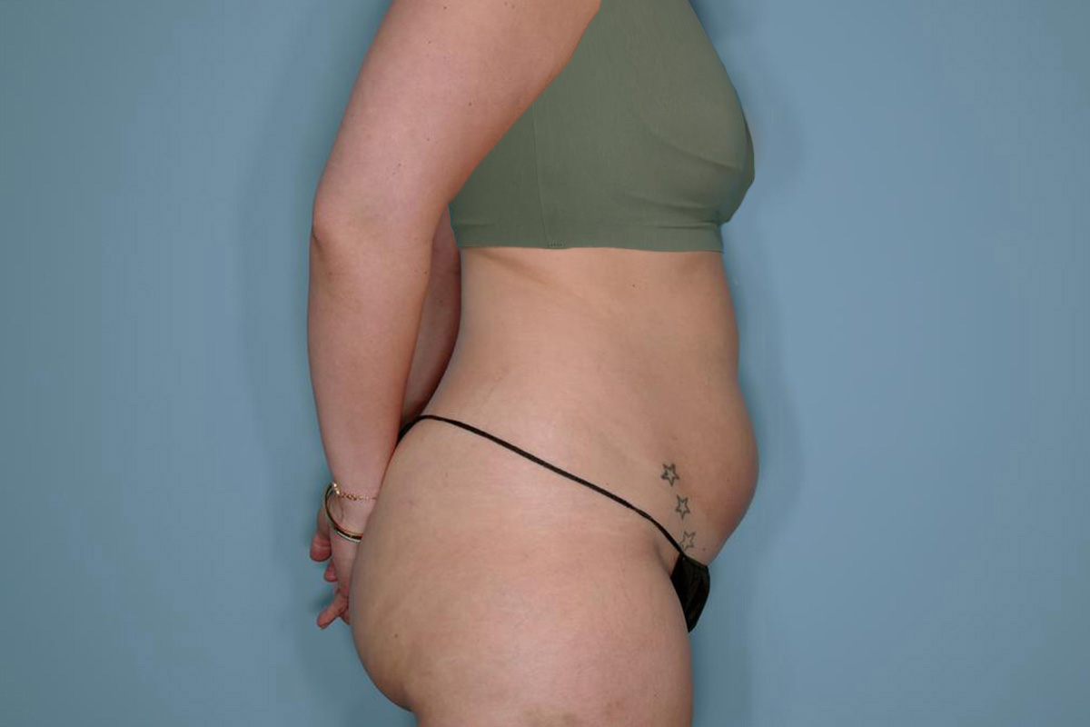 Liposuction and Renuvion J Plasma Before & After Patient #720
