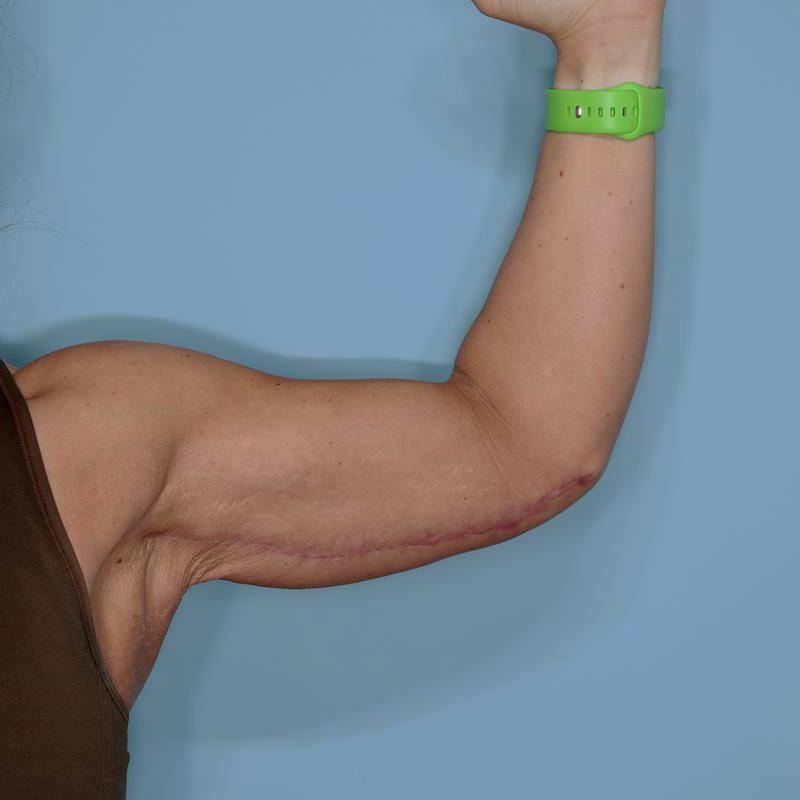Brachioplasty Before & After Patient #592