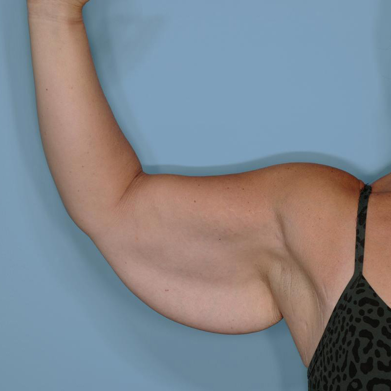Brachioplasty Before & After Patient #592