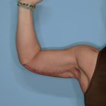 Brachioplasty Before & After Patient #592