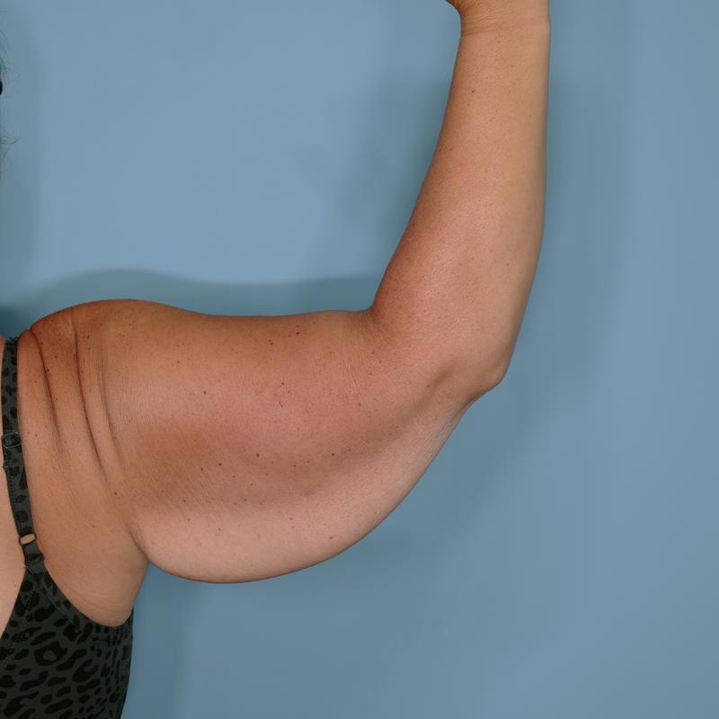 Brachioplasty Before & After Patient #592