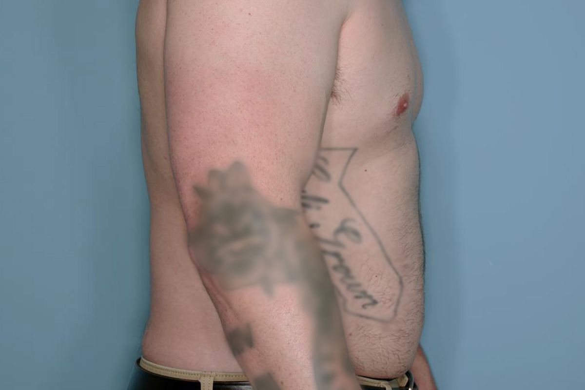 Gynecomastia Before & After Patient #718