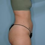 Liposuction and Renuvion J Plasma Before & After Patient #720