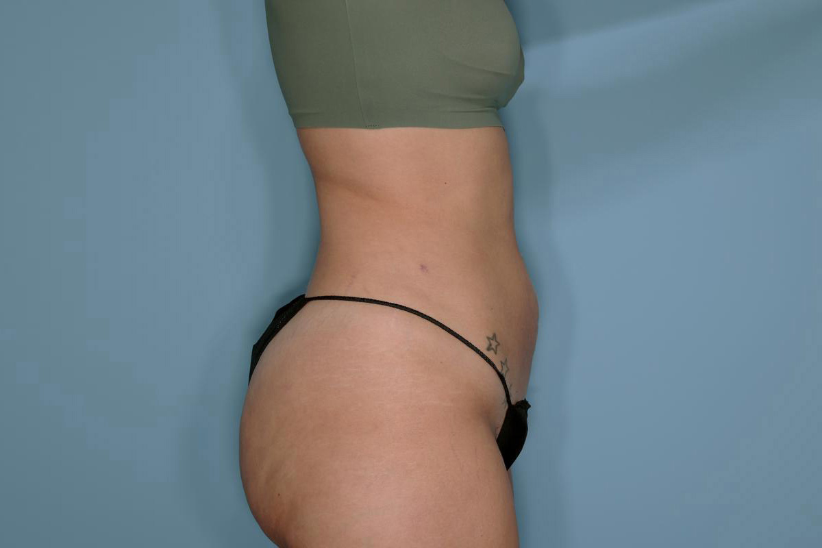 Liposuction and Renuvion J Plasma Before & After Patient #720
