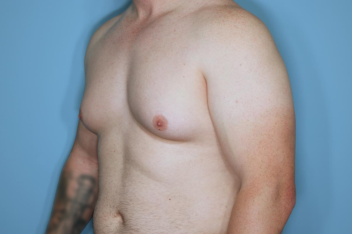 Gynecomastia Before & After Patient #718