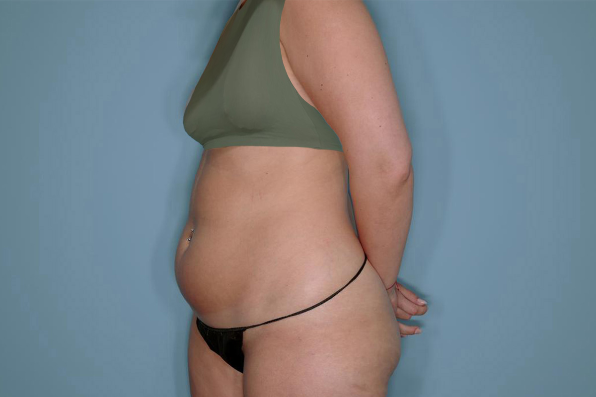 Liposuction and Renuvion J Plasma Before & After Patient #720