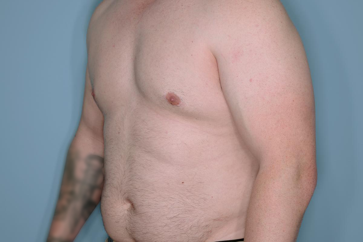 Gynecomastia Before & After Patient #718