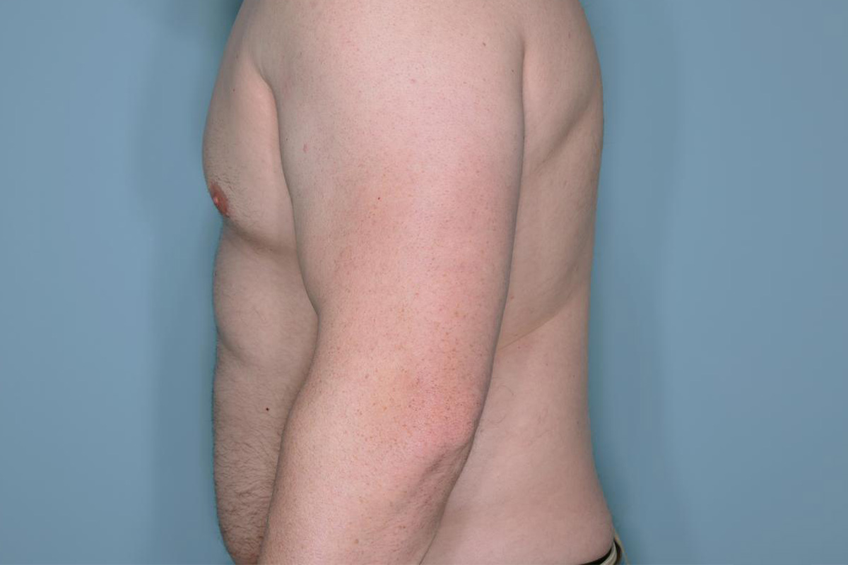 Gynecomastia Before & After Patient #718
