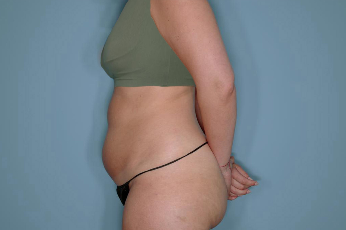 Liposuction and Renuvion J Plasma Before & After Patient #720