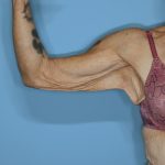 Brachioplasty Before & After Patient #604