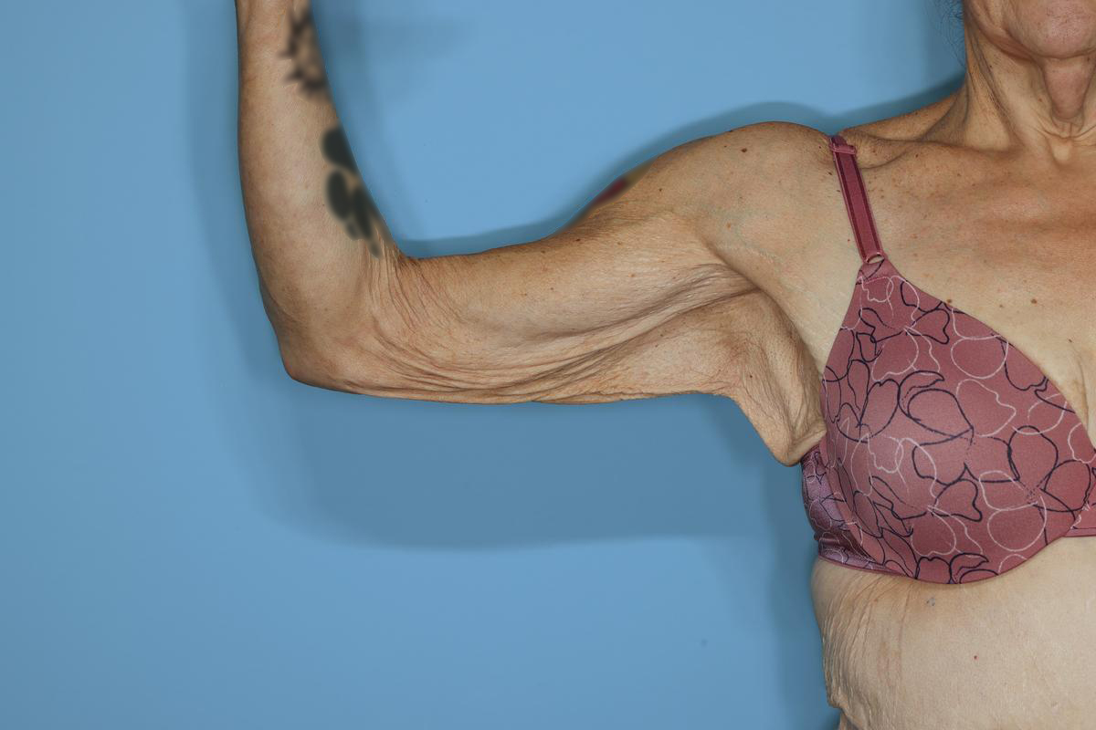 Brachioplasty Before & After Patient #604