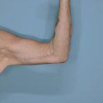 Brachioplasty Before & After Patient #604