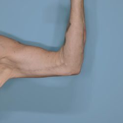 Brachioplasty Before & After Patient #604