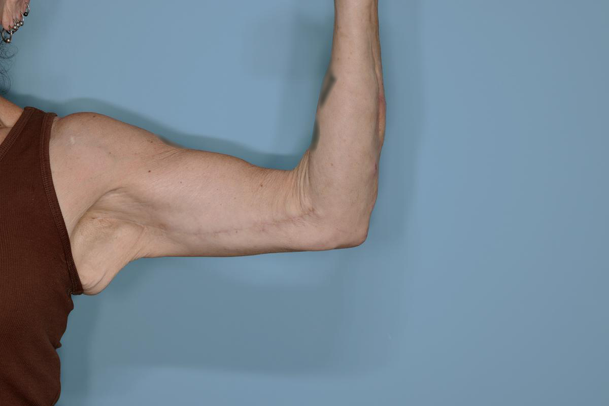 Brachioplasty Before & After Patient #604