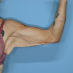 Brachioplasty Before & After Patient #604