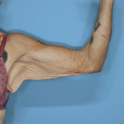 Brachioplasty Before & After Patient #604