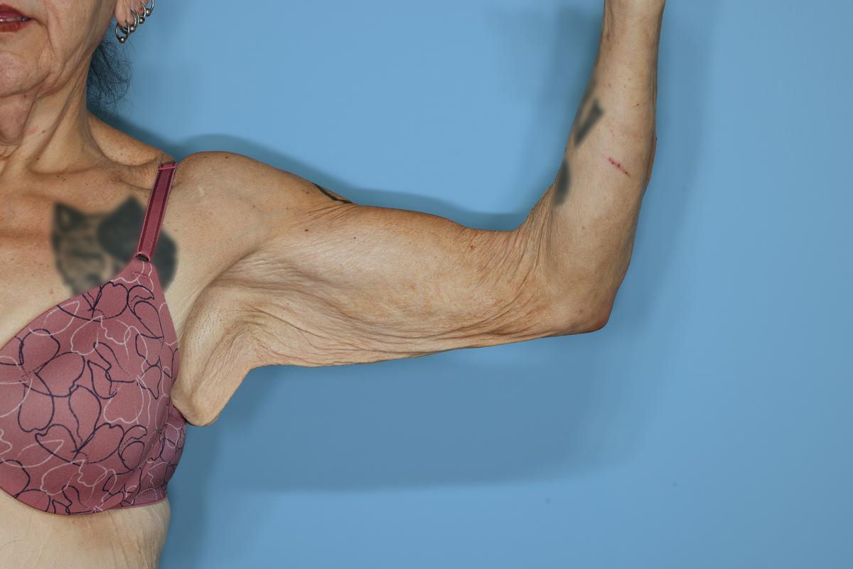 Brachioplasty Before & After Patient #604