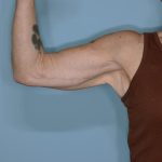 Brachioplasty Before & After Patient #604