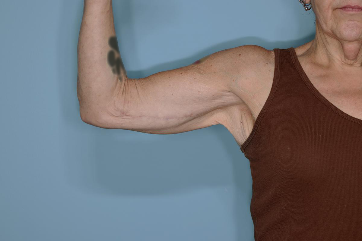 Brachioplasty Before & After Patient #604