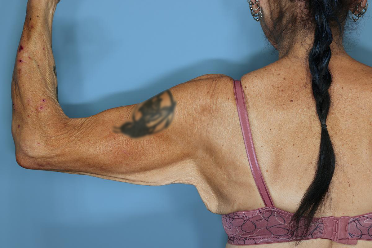 Brachioplasty Before & After Patient #604