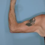 Brachioplasty Before & After Patient #604