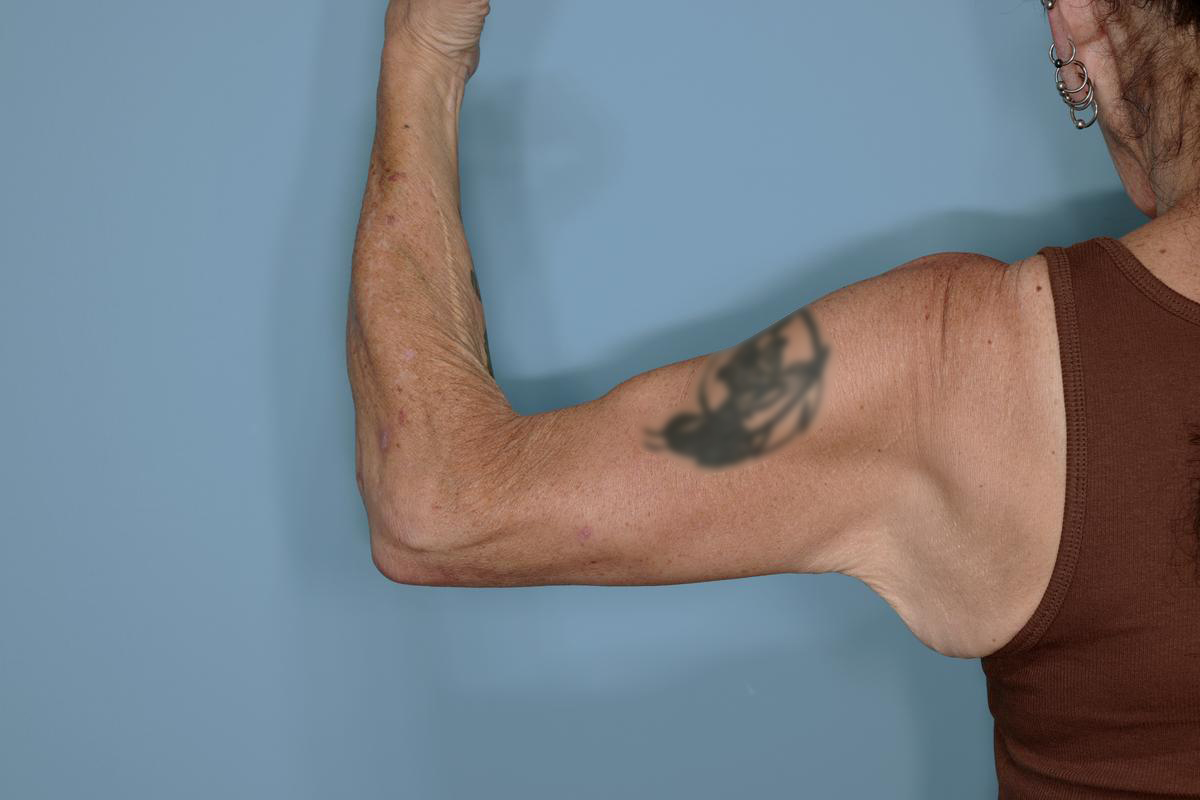 Brachioplasty Before & After Patient #604