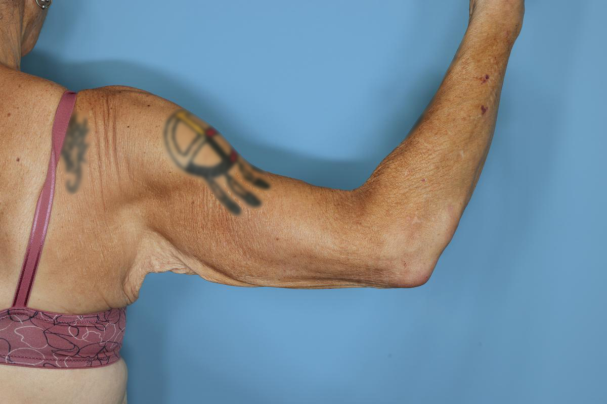 Brachioplasty Before & After Patient #604